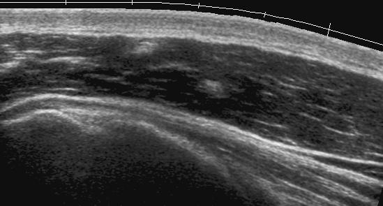 HH HH Look at the posterior labrum-capsular complex and check the posterior recess of the joint for effusion during scanning.