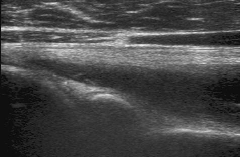 Move the transducer medial to the labrum on transverse plane to visualize the spinoglenoid notch.