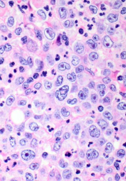 Non-Hodgkin s Lymphoma (NHL) Aggressive B-cell lymphomas (n=37) Diffuse large B-cell