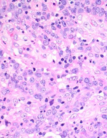Plasmablastic lymphoma (PBL): 5 cases 3 originally called DLBCL Probable Burkitt
