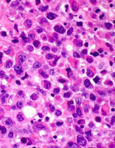 Indolent B-cell lymphomas (n=6) 4 small lymphocytic lymphoma (SLL) 1 originally called