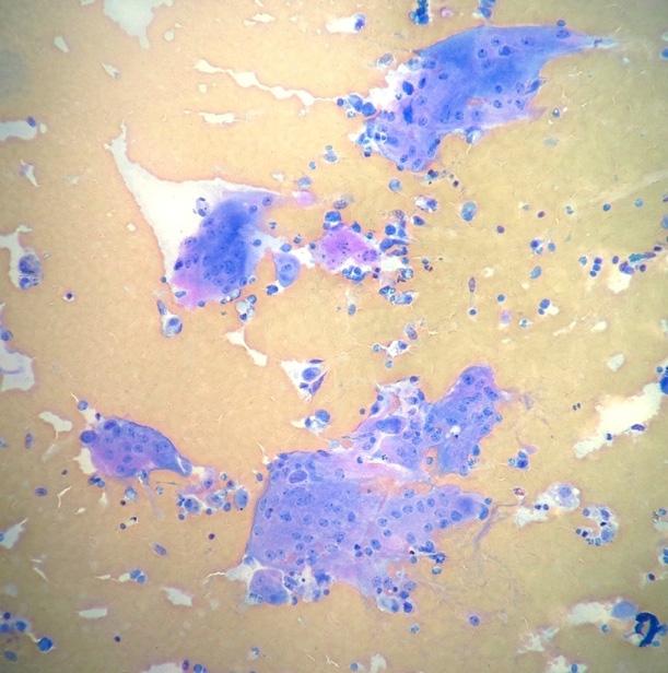 Fig. 2 (A, B) Fine needle aspirate from a subcutaneous dorsal mass in a horse. Mixed cell population on a hematic background.