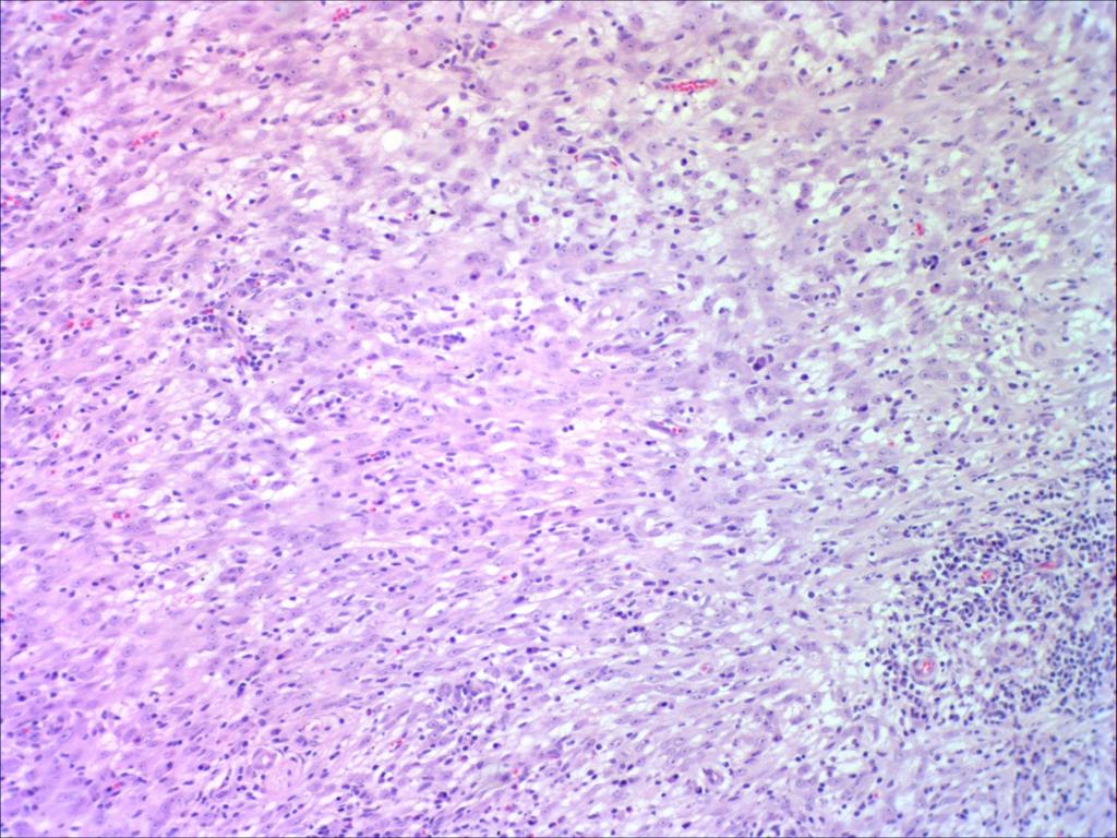 and lymphocytes were also noted. The spindle cell component was characterized by moderate amounts of elongated basophilic cytoplasm, with defined borders.