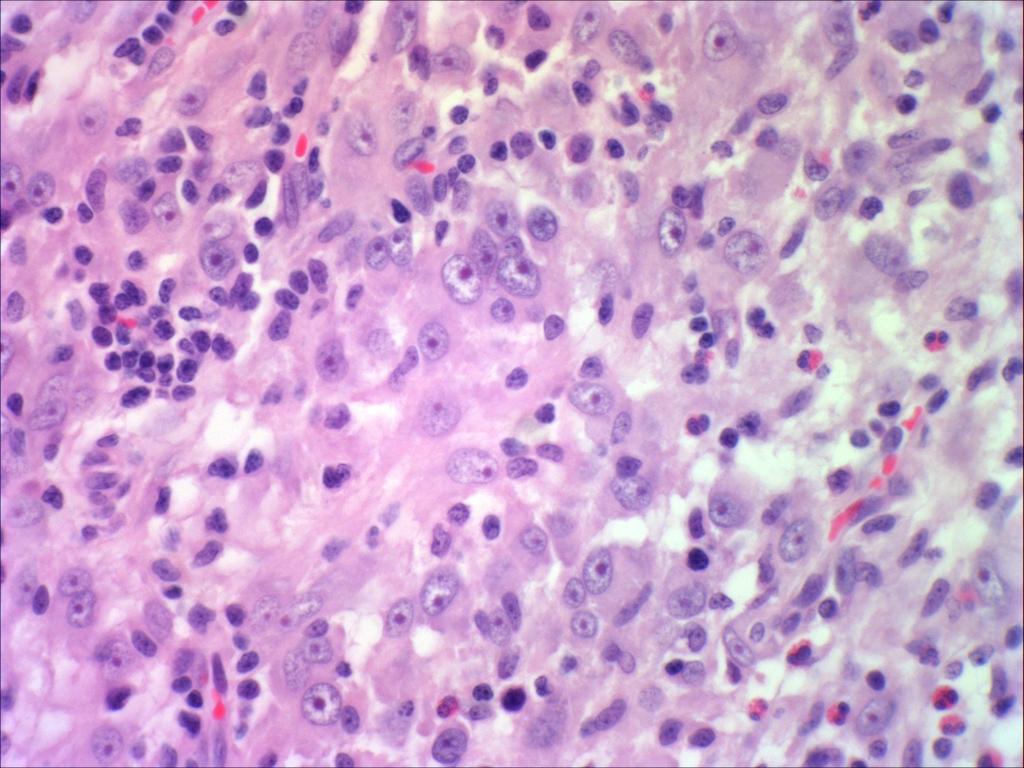 Figure 5 Subcutaneous dorsal mass, horse, histological section. Centrally a multinucleated giant cell with six nuclei is present. Mild to moderate anisokaryosis is observed.