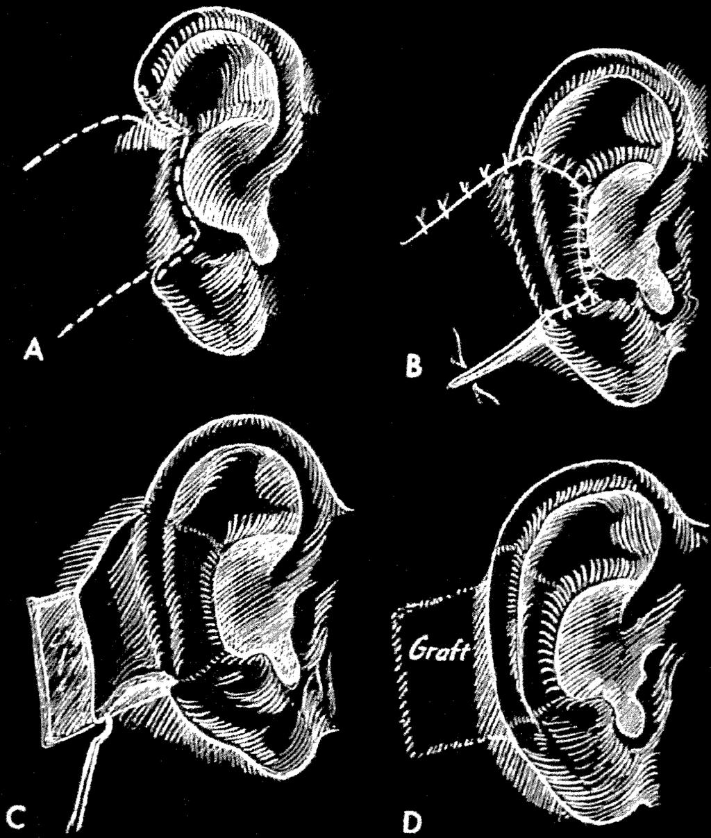 90 E.F. Aguilar III / Clin Plastic Surg 31 (2004) 87 91 Finally, the partial loss of an earlobe can be reconstructed by the use of the remaining skin or local flaps.