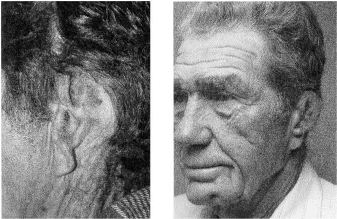 7) or the double-lobed postauricular flap of Brent (Fig. 8). The reconstruction should include the use of cartilage to maintain shape and size. Skin and cartilage loss greater than 50% Fig. 9.