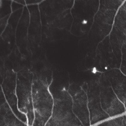 4 Ophthalmology 3 2 1 0 OCTA (with DMI) OCTA (without