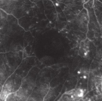 optical coherence tomography angiography (OCTA).