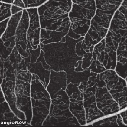 zone area on fluorescein angiography and optical