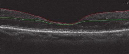 optical coherence tomography (OCT) angiography.