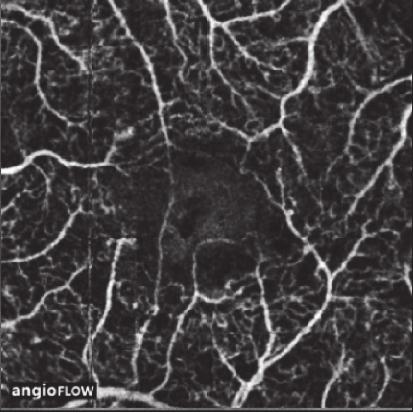 (b) Red dotted lines representing the FAZ area on optical coherence tomography angiography (OCTA) angiogram segmented at the level of the superficial retinal vasculature.