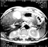 194 Magnetization Transfer MR Imaging of Hepatic Tumors Fig.