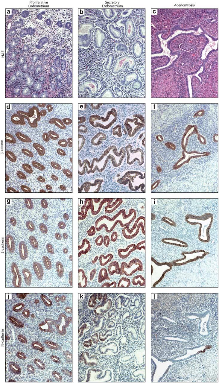 K Van Patten et al 41 Figure 1 Hematoxylin and eosin staining of (a) proliferative endometrium, (b) secretory endometrium, and (c) adenomyosis.