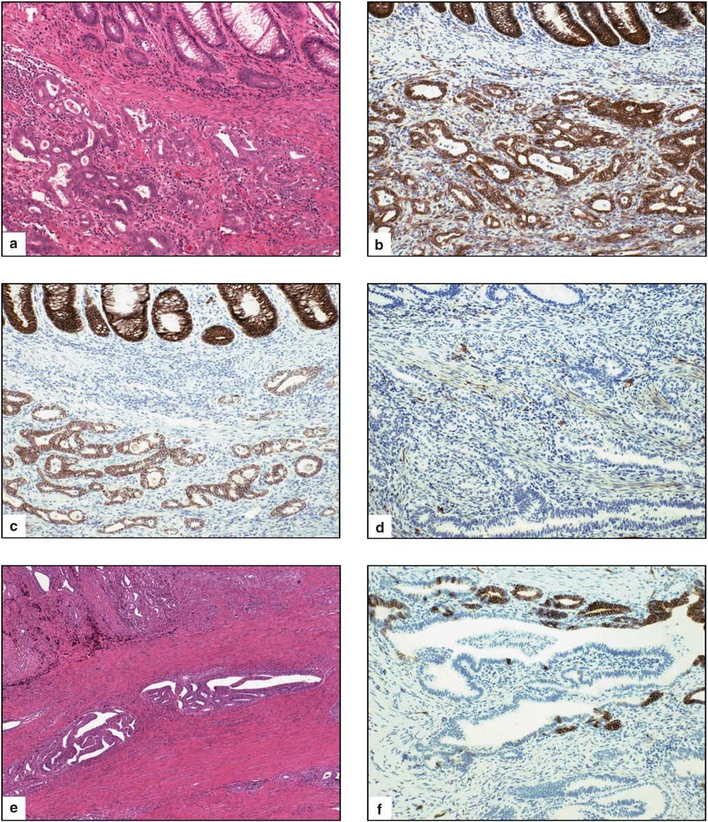 K Van Patten et al 43 Figure 3 Case of carcinoma arising in gastrointestinal endometriosis staining with (a) hematoxylin and eosin, (b) b-catenin and (c) E- cadherin showing diffuse staining, and (d)