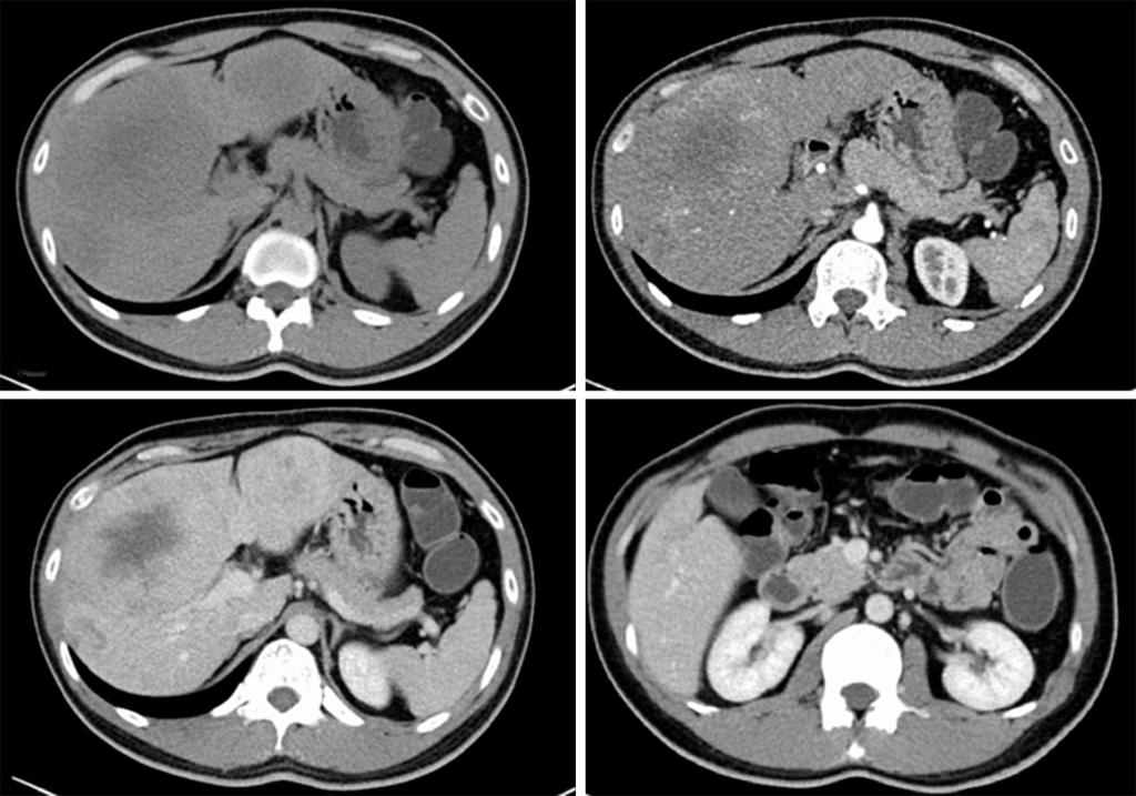 48 Ji et al. Combined LPPS C D Figure 1 Upper abdominal computed tomography. () Plain phase; () arterial phase; (C) portal vein phase; (D) portal vein phase: no suspicious of pancreatic head.