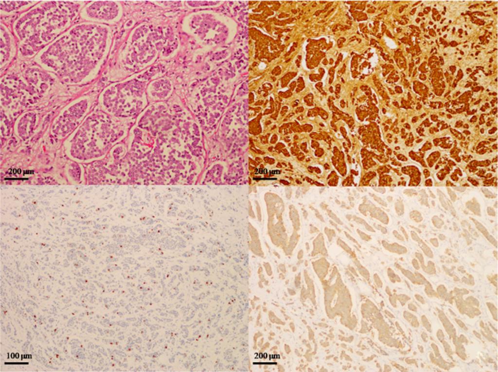 () HE staining showed small sized tumor cells with bland feature ( 20); () immunohistochemically, the tumor cells were positive for chromogranin ( 20); (C) Ki-67 staining (proliferation) showed a