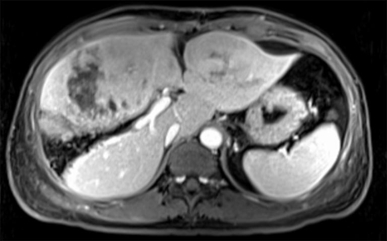 In general, corresponded to the resected metastatic liver NET, the lymph nodes in ligamentum hepatoduodenal and the MRI image, we corrected the diagnosis with PNET with liver metastases.