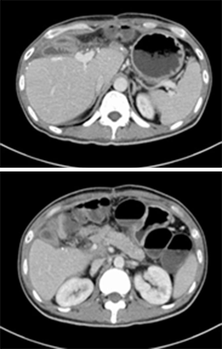 Gland Surgery, Vol 7, No1 February 2018 51 Figure 8 Recently CT scan: no evidence for tumor recurrence within the liver and pancreas.
