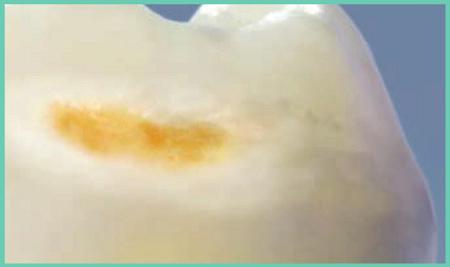 indication: Incipient caries causes mineral loss under a pseudo-intact surface layer The demineralization can affect a pore