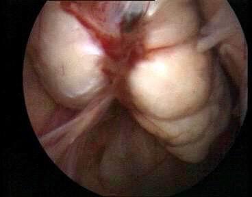 Site of cortical invagination with endometriotic implant,