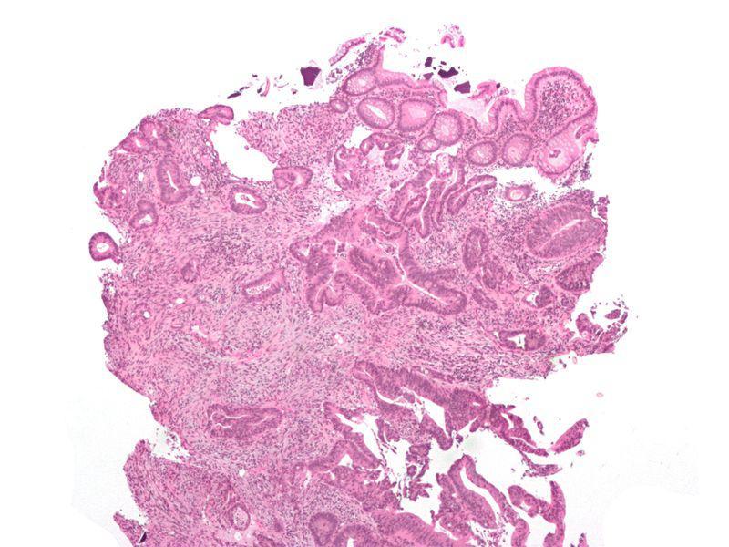 Colon Cancer Image from: http://commons.