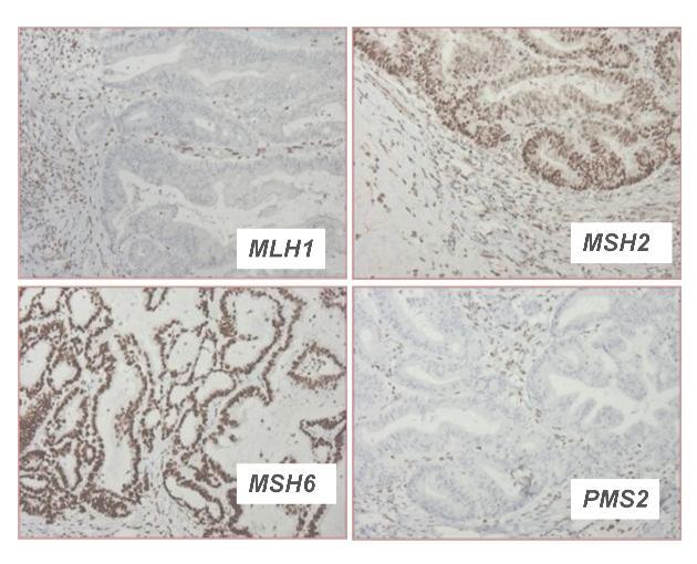 Colon Cancer MMR protein expression tested by IHC.