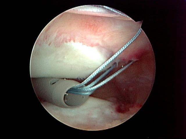 Patellar Instability Surgical Options Proximal realignment Acute repair MPFL