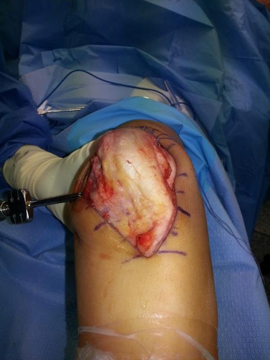 Proximal realignment Patellar Instability Surgical Options Acute repair MPFL