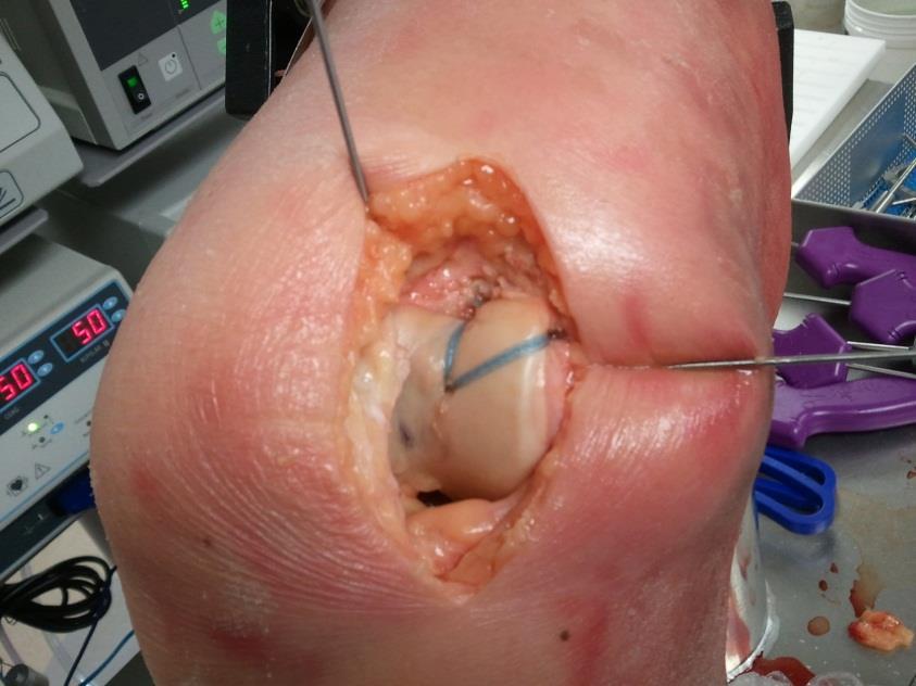 Patellar Instability Surgical Options Proximal realignment Acute repair MPFL Open/Arthroscopic