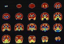 Patient Evaluation Cortical mapping via fmri and cortical stimulation near eloquent areas, for language