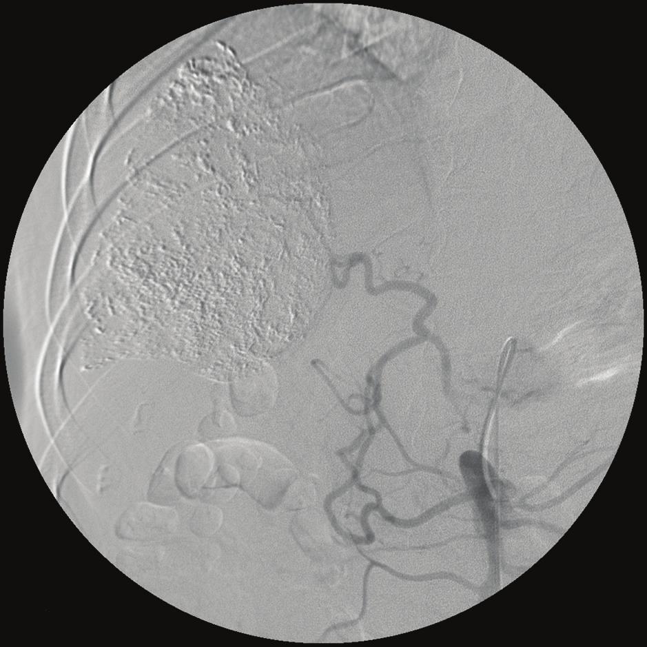 (b) Angiography demonstrated the collateral arteries that originated from the superior mesenteric artery. (c) Angiography showed good opacification of the portal vein.