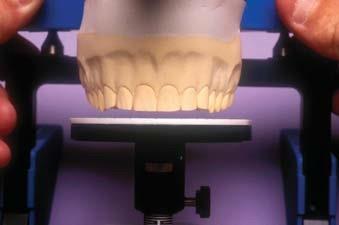 The technician can now add wax or porcelain until it touches the waxing guide for a determined incisal length to be fabricated.