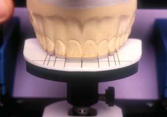 Knowing the new incisor length that will be restored, measure from the nasial-labial to new incisal edge to be fabricated and