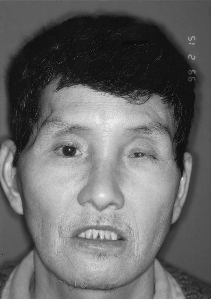Volume 130 Number 2 Ducic and Pontius 185 Fig 10. Postoperative frontal view of patient in figure 9 following nasal root calvarial bony reconstruction and upper lateral cartilage resuspension.
