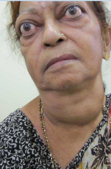 MRS SN 60/F: GRAVES DISEASE Anterior neck swelling -12 yrs Anxiety, Palpitations, tremors, weight loss- 11 yrs Protrusion