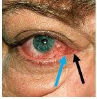 Conjunctival redness 6. Chemosis 7.