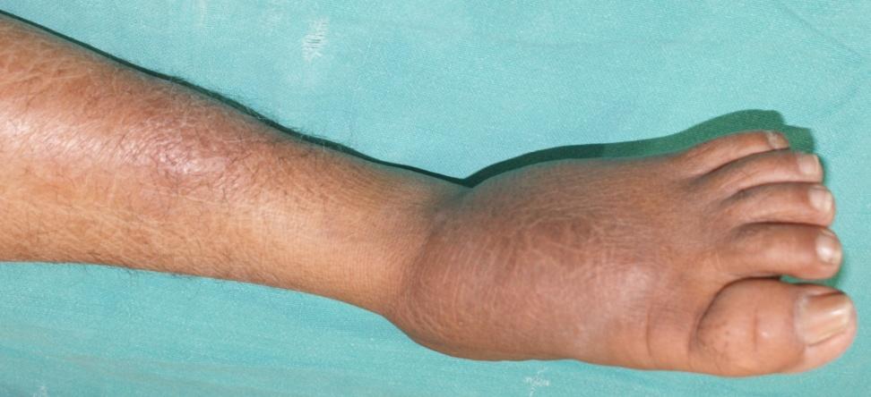 SKIN CHANGES Graves dermopathy Raised waxy pretibial lesions