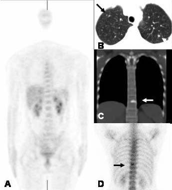 Tsang YW et al /CT (Figure 1B and 1C) scan were then performed. images (Figure 1A) appeared normal.