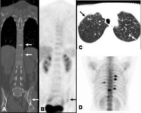 /CT Bone metastases of breast cancer in and bone scan Figure 2. Patient s /CT and bone scan after chemotherapy and hormone therapy.