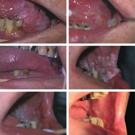 A1 A2 627 A3 B1 B2 B3 Figure 1 Clinical photographs of patients with oral verrucous hyperplasia (OVH) before and after the laser light-mediated topical ALA-PDT treatment.