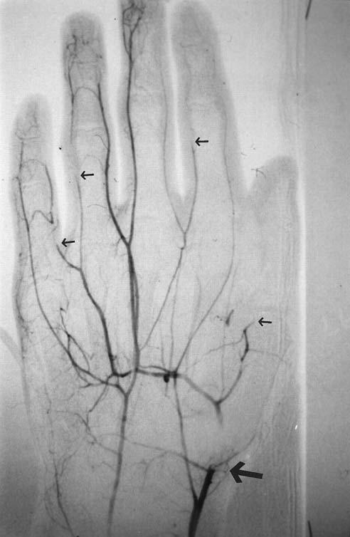 Diagnostic Modalities Arteriography Gold Standard for diagnosis of Acute Limb Ischemia For pts with viable limbs