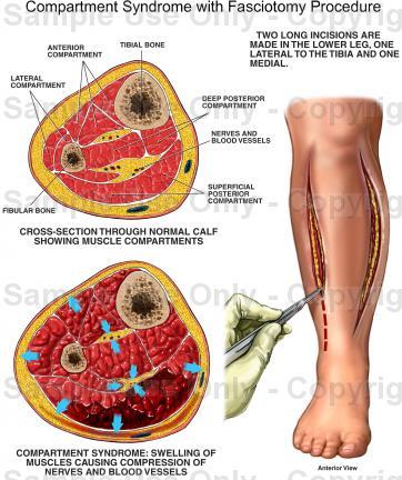 Compartment Syndrome History Significant Pain Nerve Impairment Motor Dysfunction Mechanism and Duration of Injury Anticoagulation Physical Severe pain at rest