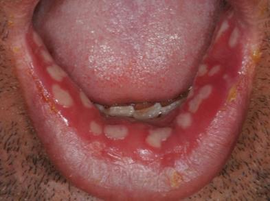 aphthous ulcers: Typical oral presentation Repeated episodes of selflimiting ulceration: - Labial, buccal or ventral tongue - Oval shape - Size <10mm - Resolve <14 days - Sites of ulcers vary -