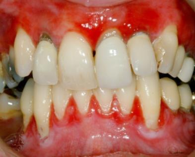 Desquamative Gingivitis: Typical oral presentation Red Flags: Level 3 Referral 11 Bright band of redness of the attached gingivae that: - Cannot be attributed to dental plaque.