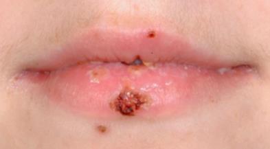 Crusted lip lesions: Typical oral presentation Red Flags: Level 3 Referral - Crusted lesions on the external lips. - Sudden onset.