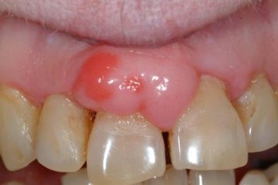 13 Focal soft tissue lumps and bumps: Fibroepithelial Polyp: Typical oral presentation Note: traumatic hyperkeratosis also present along the occlusal line in the lower image.