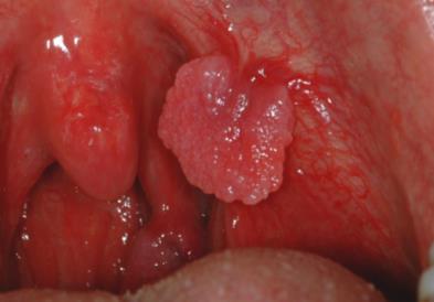 14 Mucocoele: Typical oral presentation Soft tissue swelling: - Lower lip mostly - Rapid size increase (hours/days) - Domed broad base (not pedunculated) - Can