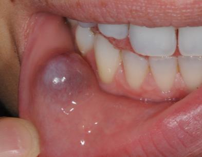Wart: Typical oral presentation Focal soft tissue swelling: - Warty, irregular surface - Pedunculated (on a stalk) or broad base - May affect any intraoral site including