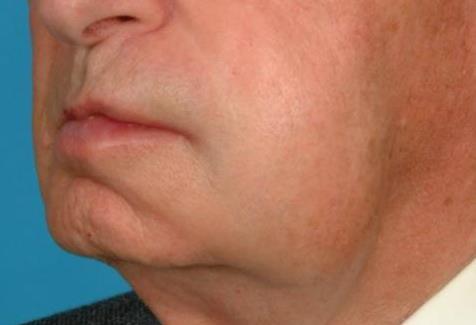 15 Sudden Onset Orofacial Swelling: Typical oral presentation - Swelling of the orofacial soft tissues left lower face in this case. - Lesions may be unilateral or bilateral with variable symmetry.