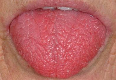 Salivary Gland Presentations Oral Dryness (Xerostomia) Typical presentation Dry mouth (although not always as dry as the case illustrated) that may be associated with: - Difficulty chewing and